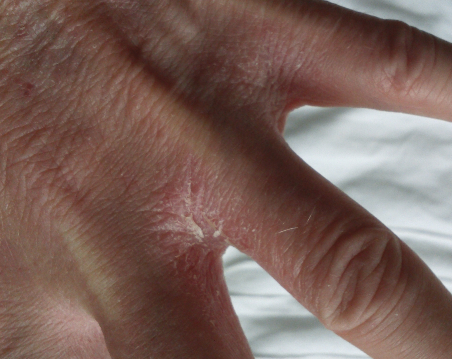 TOXIC HEALTH CO UK Eczema hand getting dry with cracking